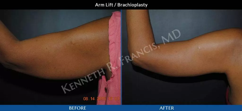 Arm Lift - Brachioplasty
