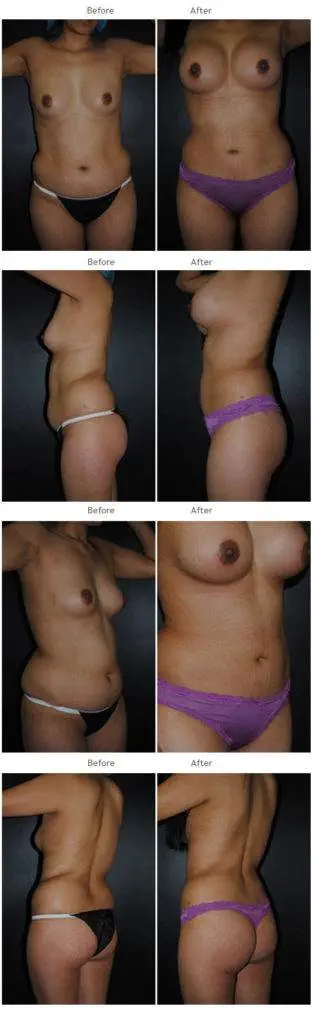Mommy makeover before and after 6 Mommy Makeover