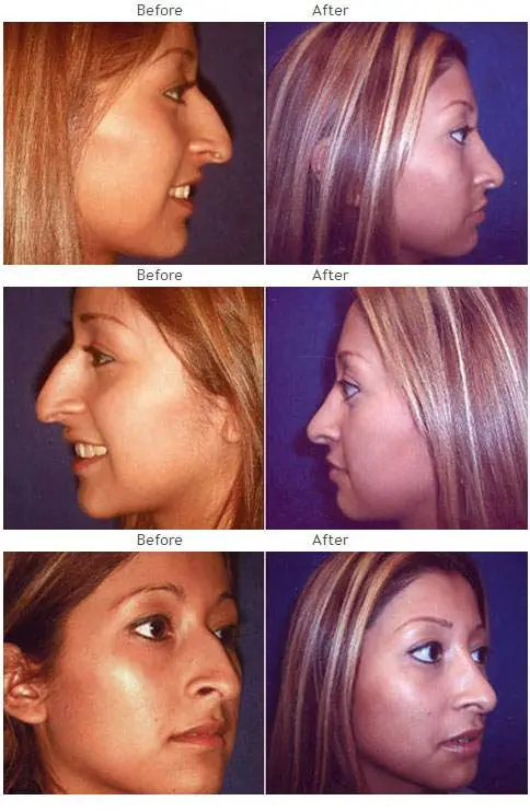 Rhinoplasty before and after 5 Rhinoplasty (Nose) before and after