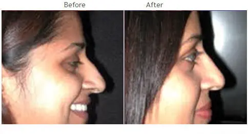 Rhinoplasty before and after 6 Rhinoplasty (Nose) before and after