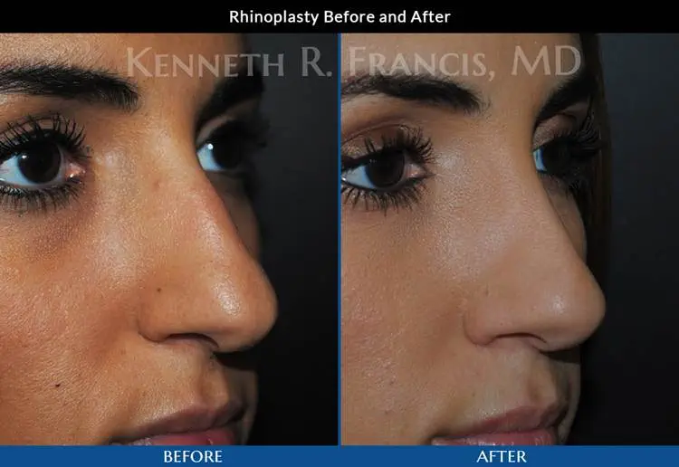 Rhinoplasty before and after 4 Rhinoplasty (Nose) before and after