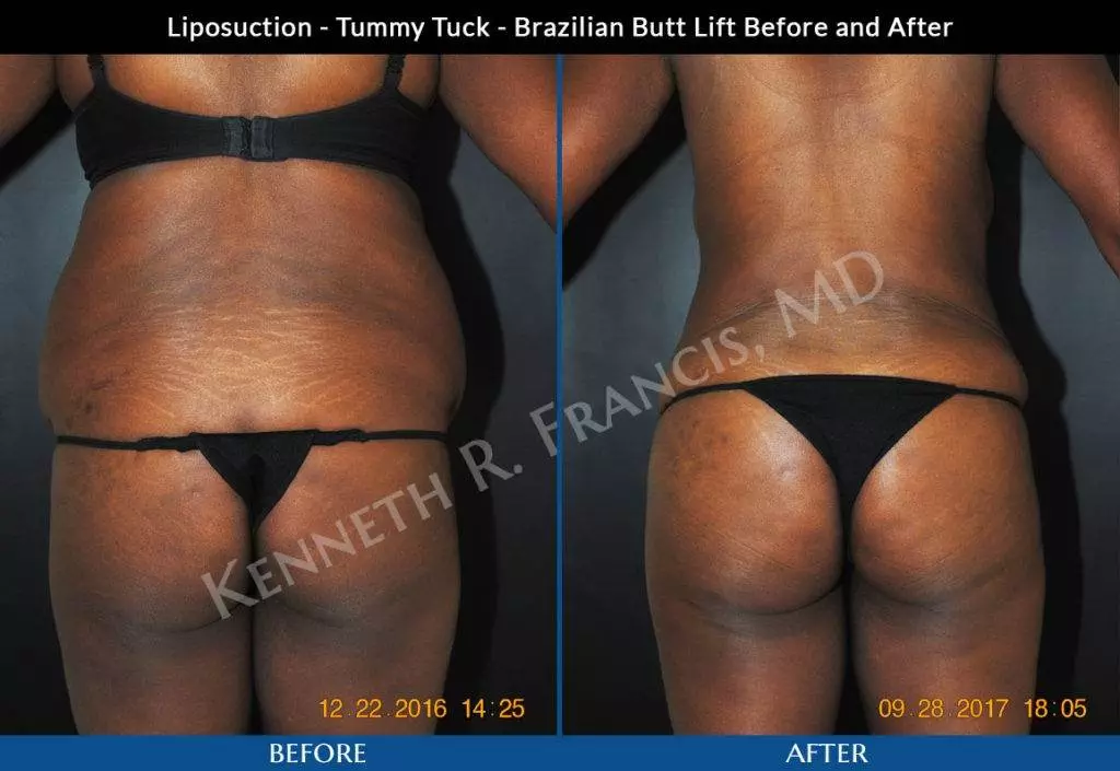 Liposuction, Brazilian butt lift, Tummy tuck NYC