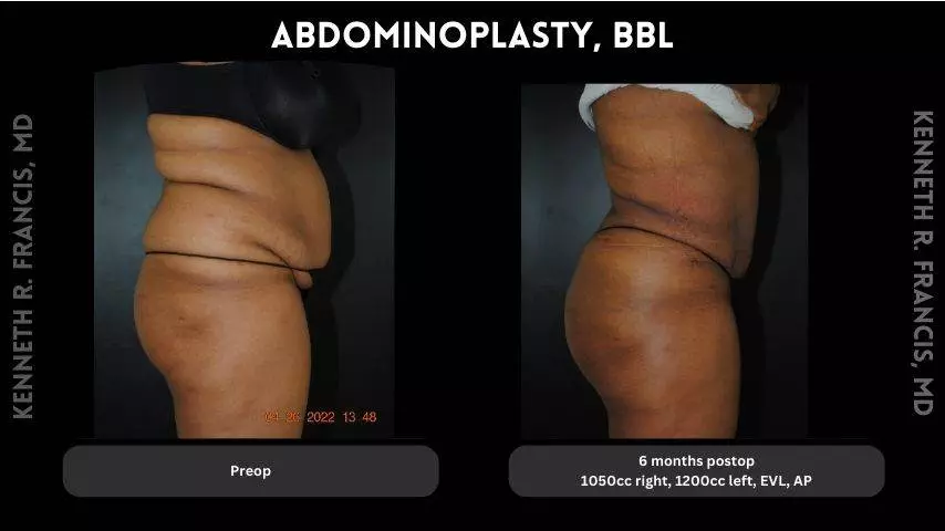 Abdominoplasty, BBL