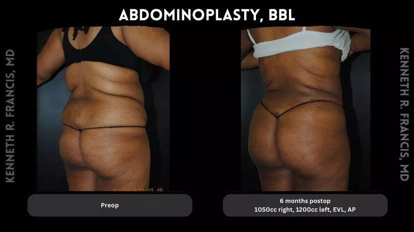 Abdominoplasty BBL 9
