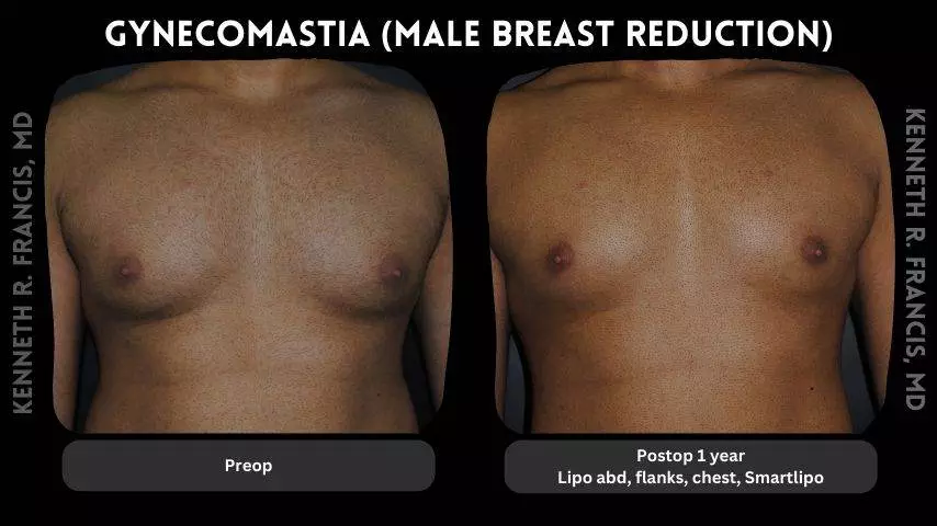 Gynecomastia Male Breast Reduction 2