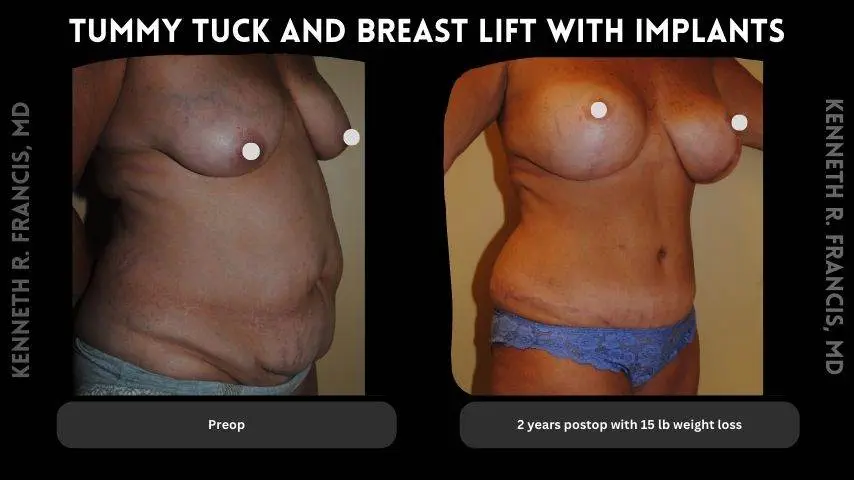 Tummy tuck and breast lift with implants