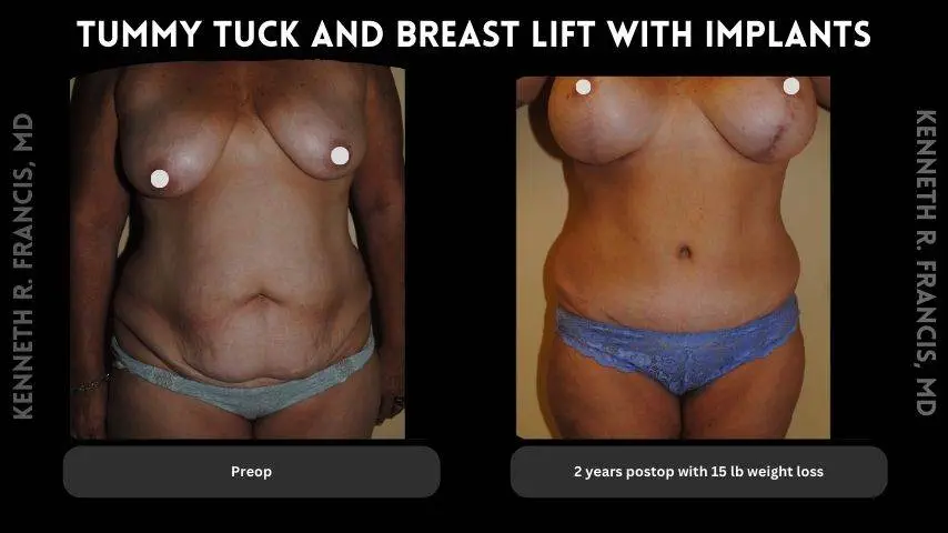 Tummy tuck and breast lift with implants