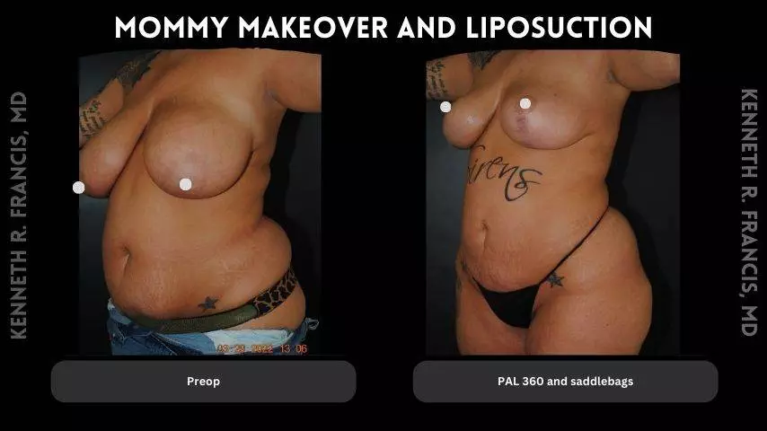 mommy makeover and Liposuction