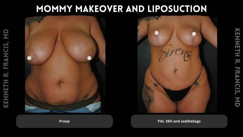 Mommy makeover before and after 2 mommy makeover and Liposuction