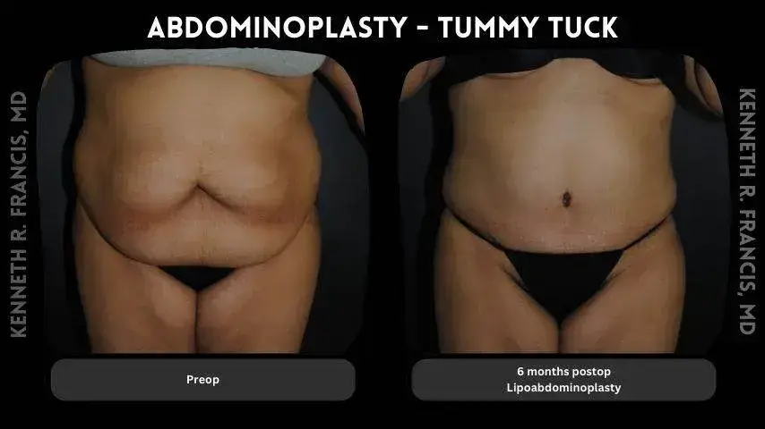 vertical tummy tuck surgeon in Park West Village Manhattan NYC vertical tummy tuck surgeon in Park West Village Manhattan NYC