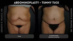 Liposuction Recovery Optimization Kit - POST OP RECOVERY