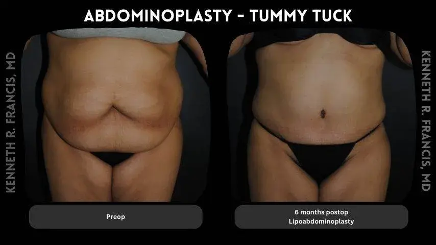 scarless tummy tuck before and after in Koreatown Manhattan NYC