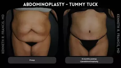 scarless tummy tuck before and after in University Village Manhattan NYC