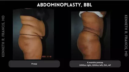 drainless tummy tuck before and after in Alphabet City Manhattan NYC