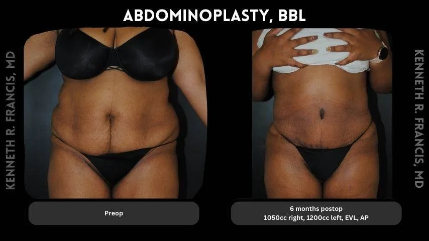 scarless tummy tuck before and after in University Village