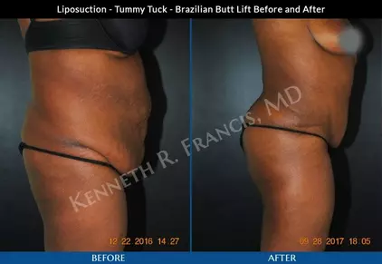 Full Tummy Tuck NYC  Full Abdominoplasty Manhattan & Bronx